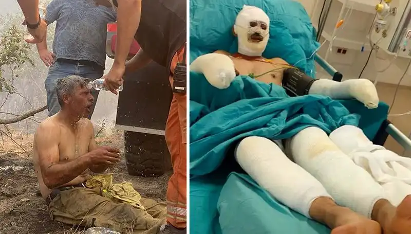 Orman İşçisinin Yanık Tedavisi Devam Ediyor: Korkunç Olayın Ayrıntıları